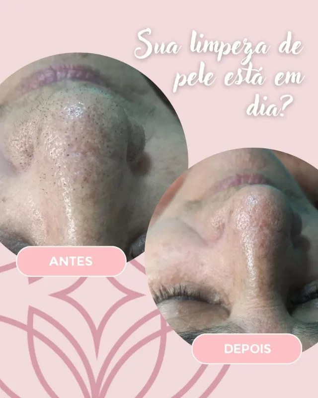 Limpeza de Pele